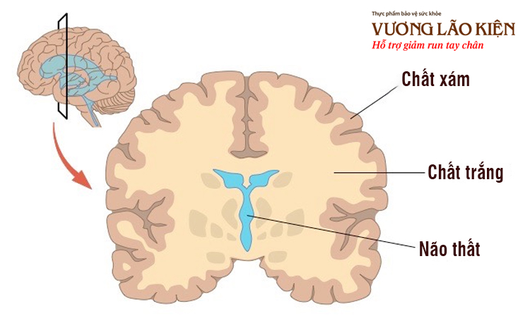 Thoái hóa chất trắng não xảy ra khi bao myelin của sợi trục thần kinh bị tổn thương